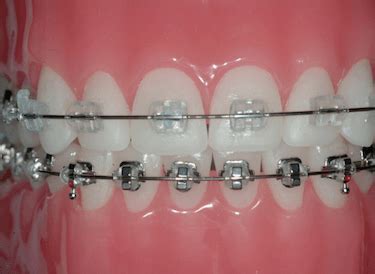 diferencia brackets metalicos y zafiro|brackets de zafiro precio.